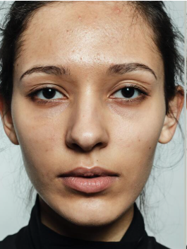Before treatment